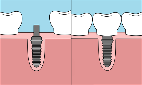 Implantat Bornholm tandklinik